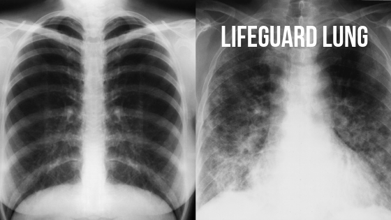 lifeguard lung, granulomatous pneumonitis, chloramines, indoor pool air quality