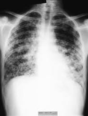 lung1.jpeg lung1.jpeg
