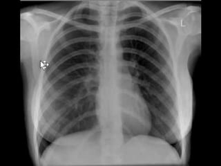 lung2.jpg